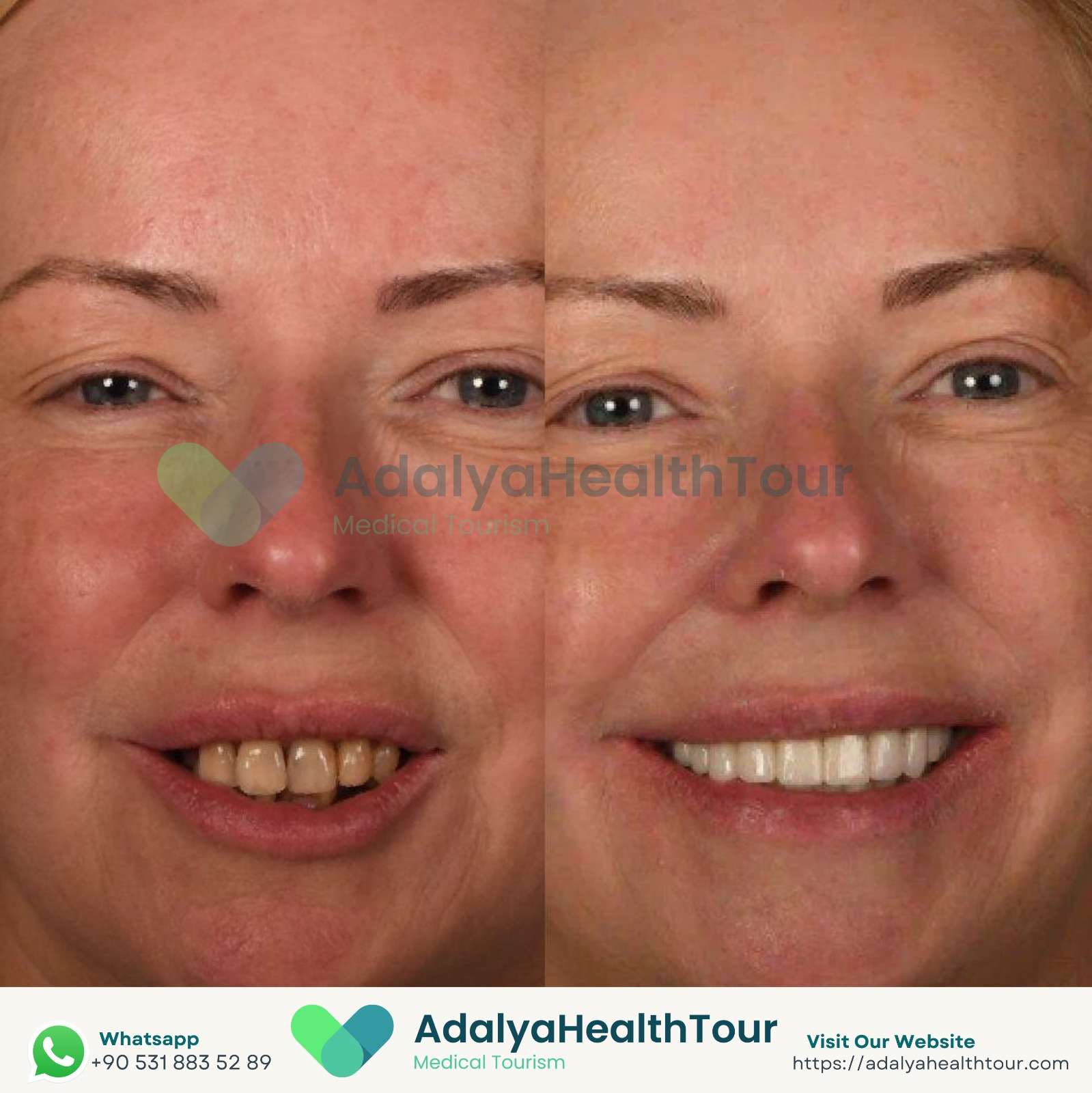 dental implants turkey antalya zirconia crown price cost medical health tourism istanbul