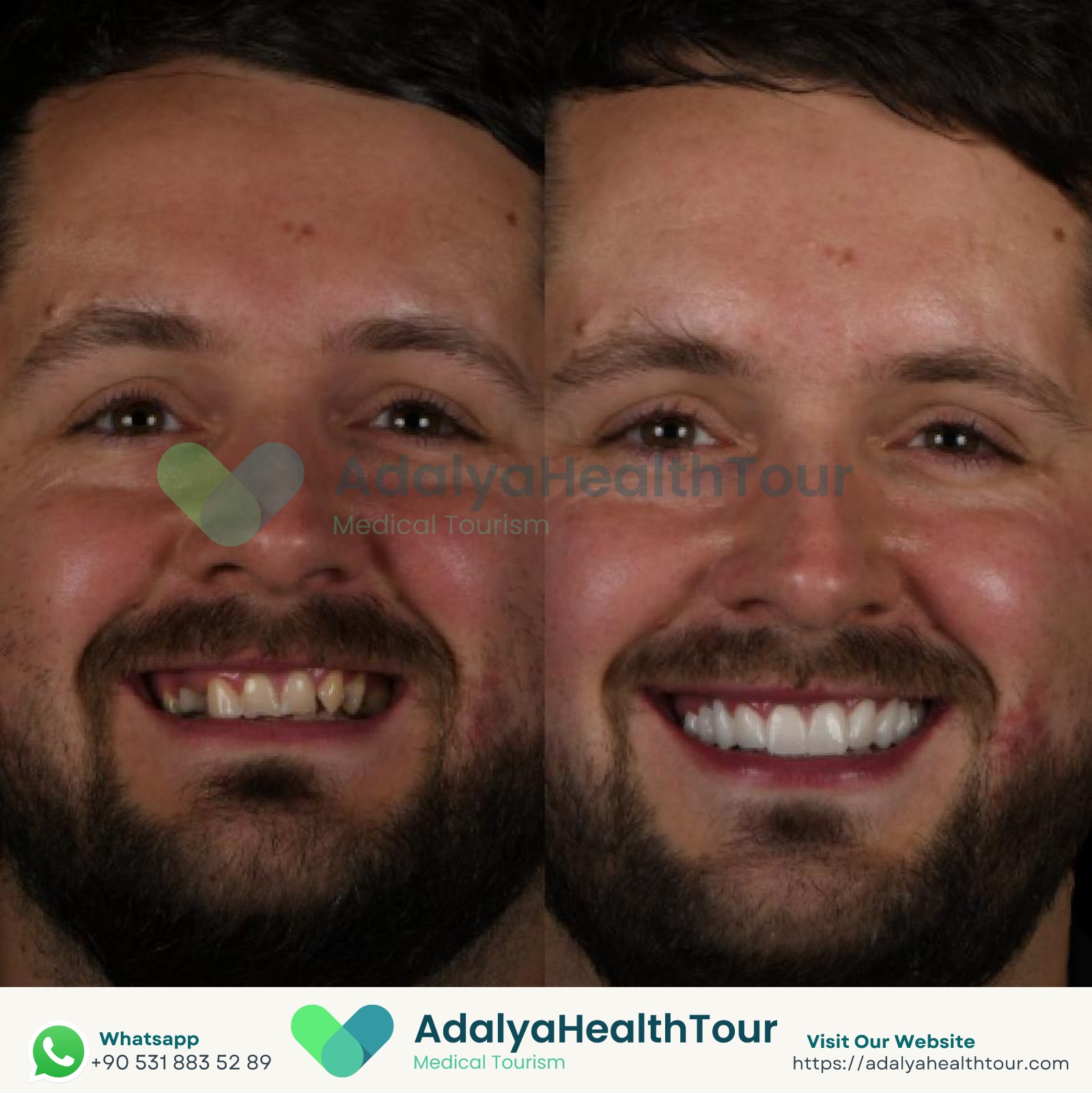 dental implants turkey antalya zirconia veneers crown price cost medical health tourism istanbul