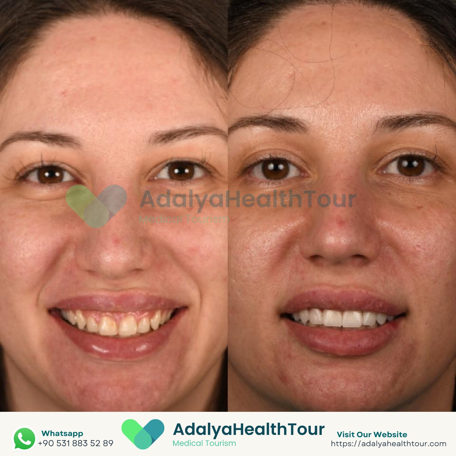 emax veneers crowns turkey antalya cost price medical health tourism istanbul