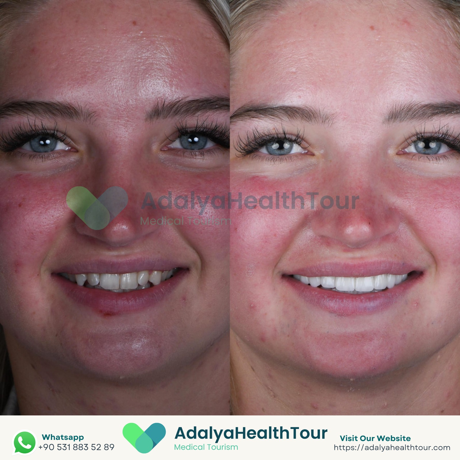 emax veneers crowns turkey antalya price cost medical health tourism istanbul