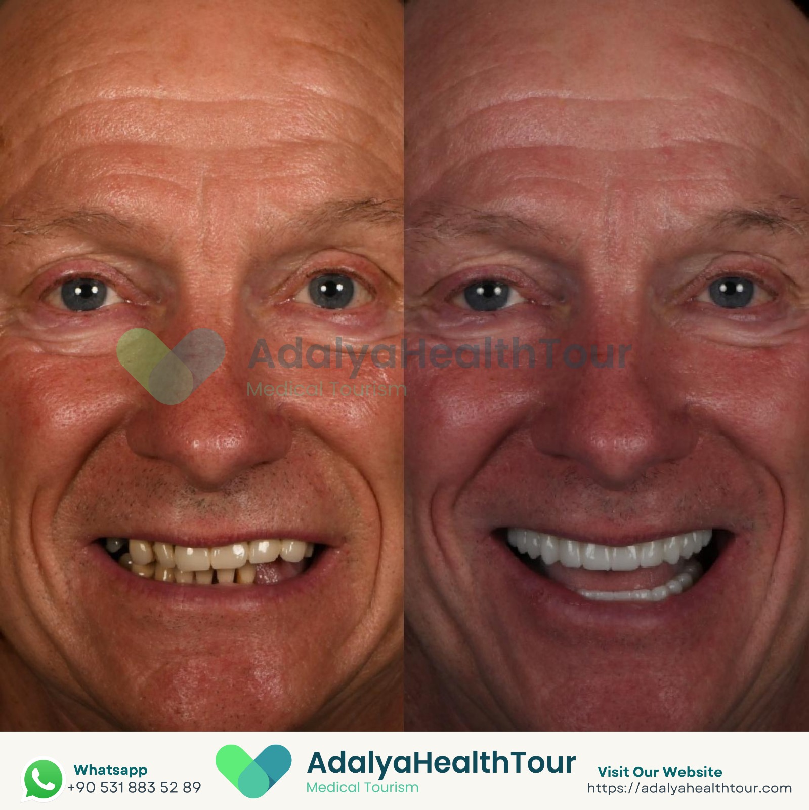 full mouth dental implants turkey package deals price medical health tourism antalya istanbul all on 4 6