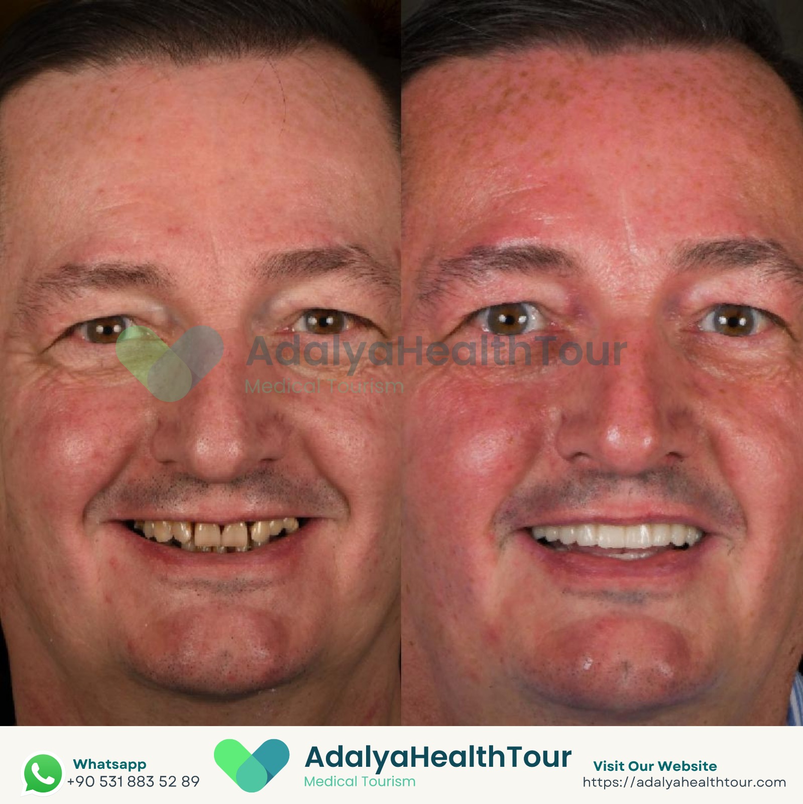 full mouth dental implants turkey package deals price medical health tourism antalya istanbul cost