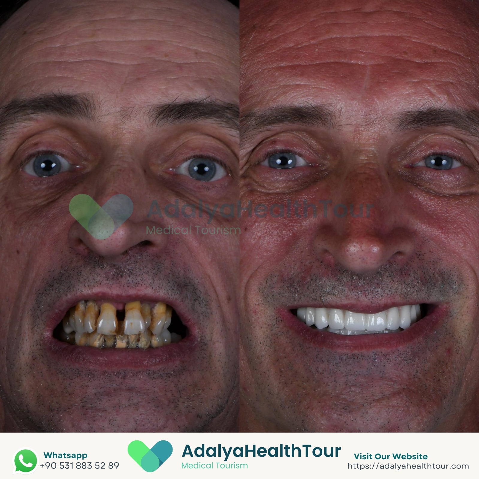 full mouth dental implants turkey package deals price medical health tourism antalya istanbul