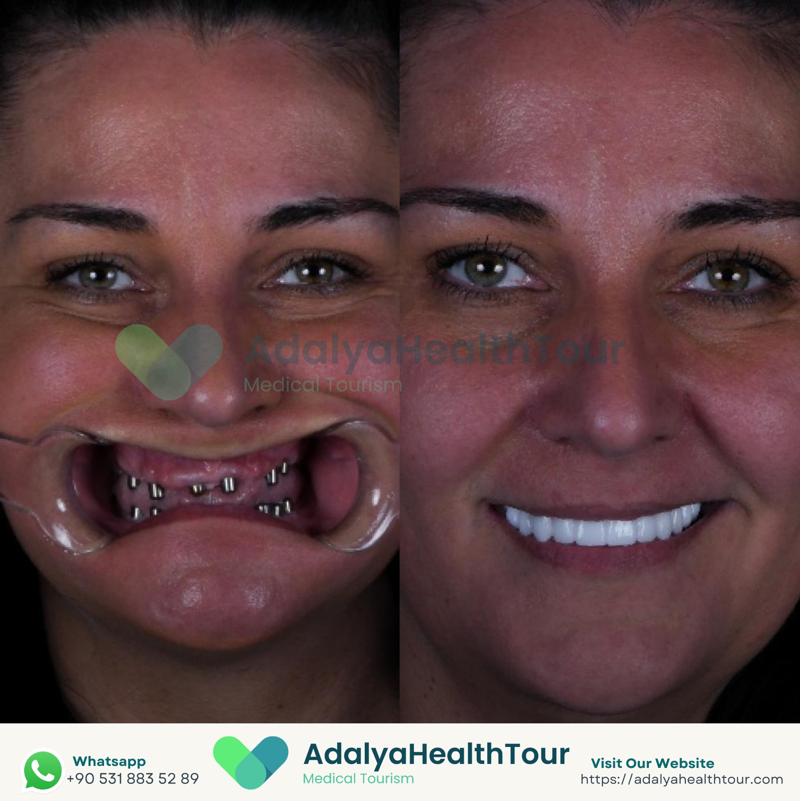 full mouth dental implants turkey package deals price medical health tourism istanbul antalya