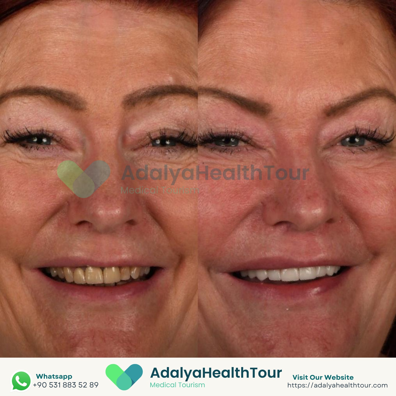 medical dental tourism health turkey zirconium crowns prices packages cost antalya istanbul