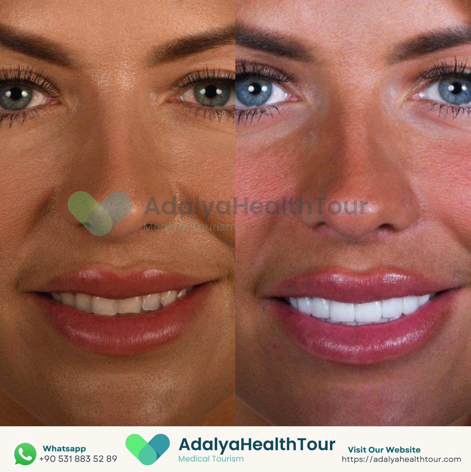 medical dental tourism turkey antalya hollywood smile zirconia crown price packages cost