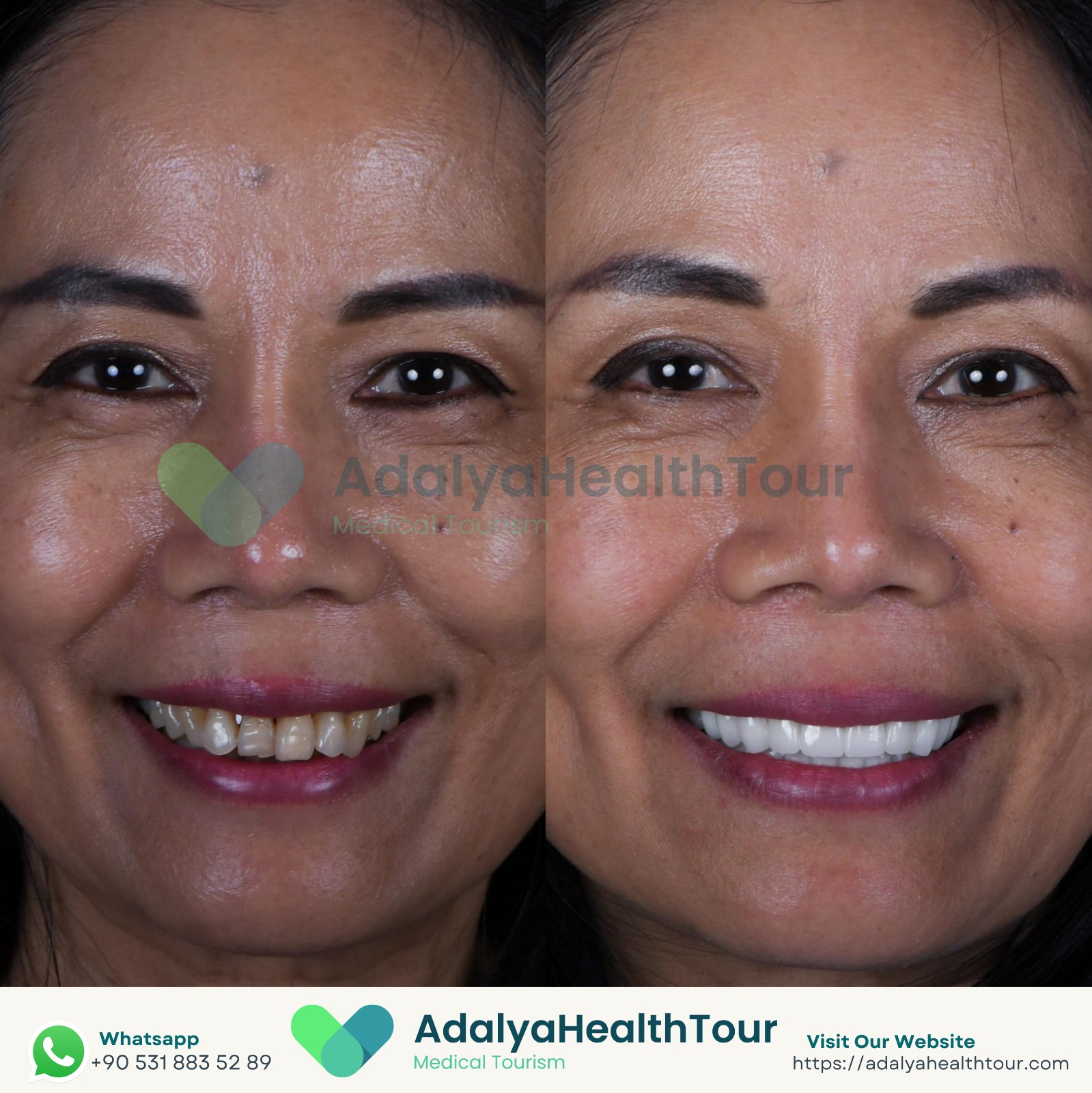 medical dental tourism turkey zirconium crowns prices packages cost antalya istanbul