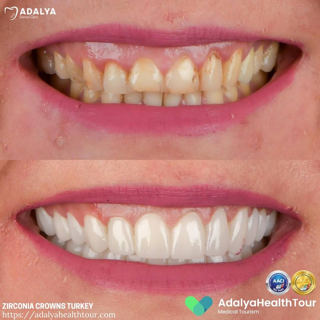 before after turkey teeth