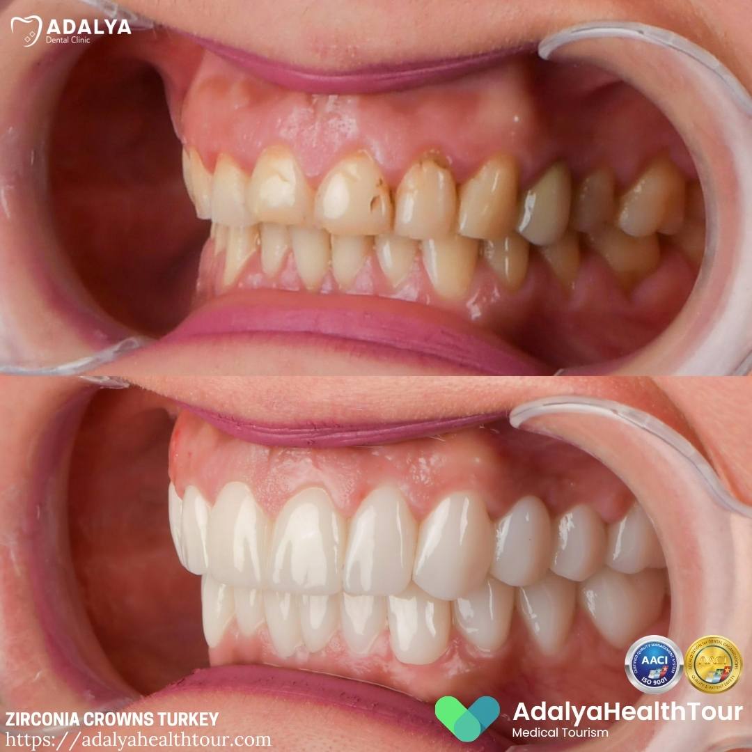 before and after turkey teeth crowns