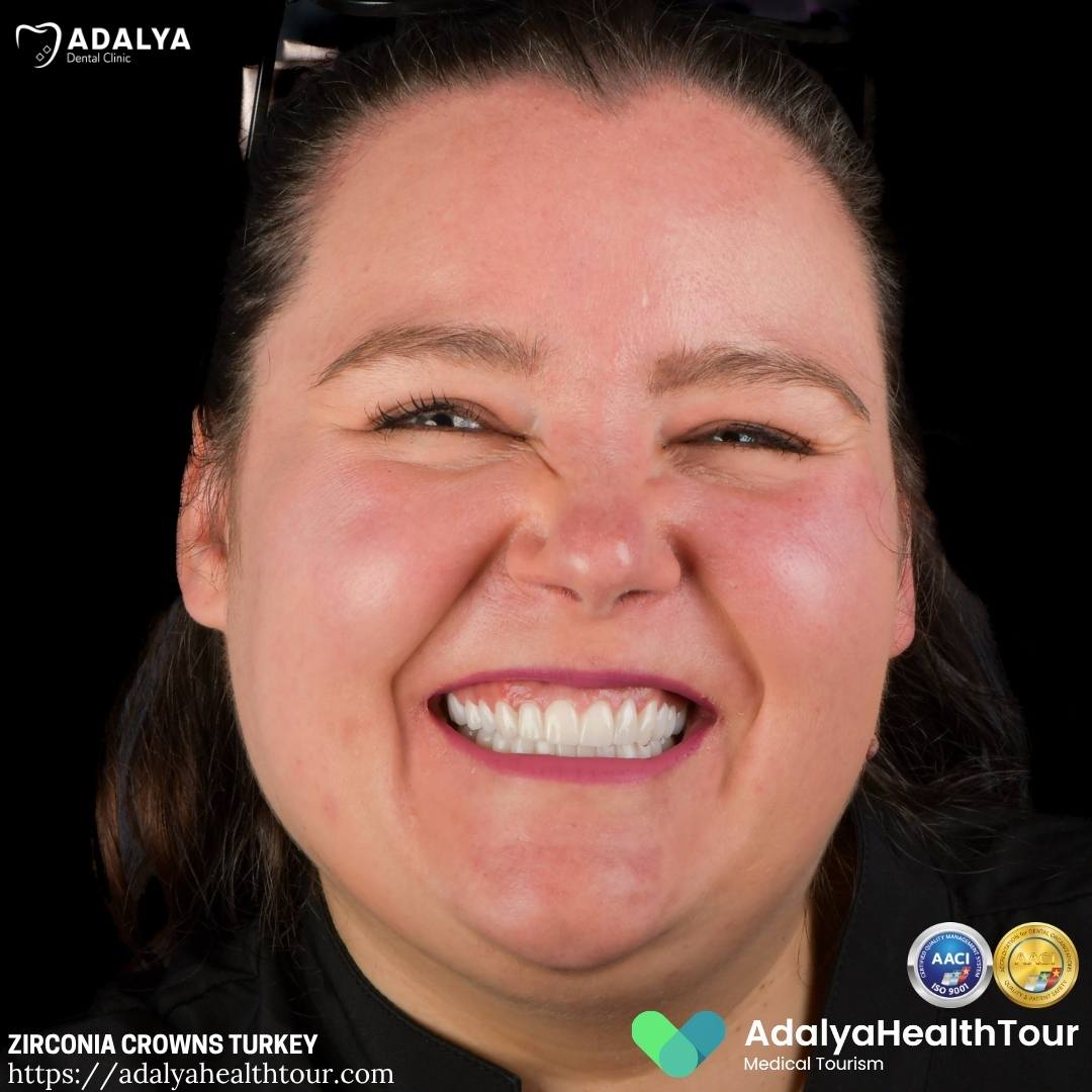 before and after turkey teeth german patient