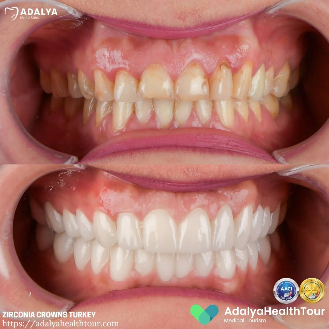 before and after turkey teeth