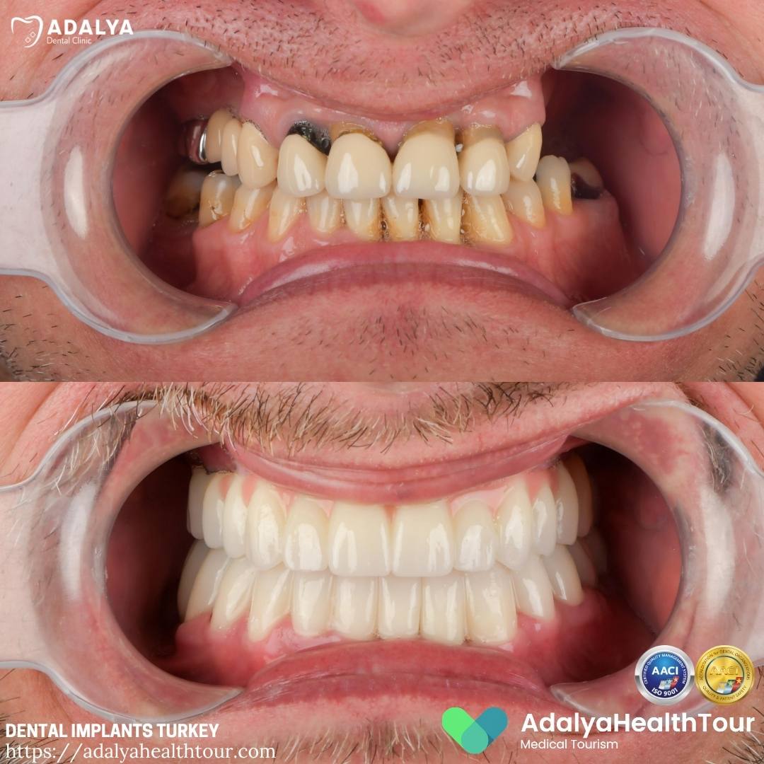 dental clinic antalya turkey