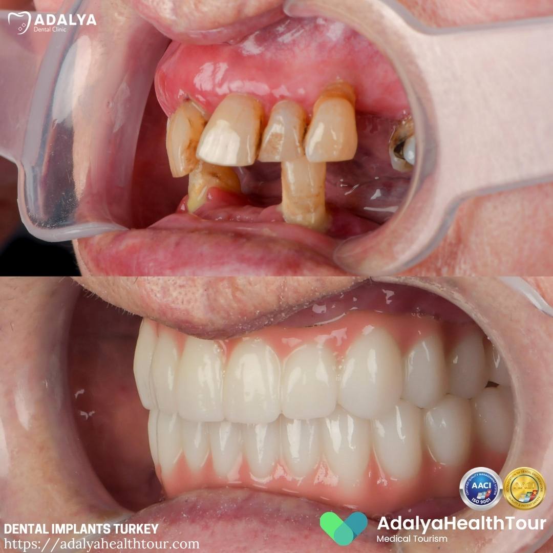 dental implants turkey before after