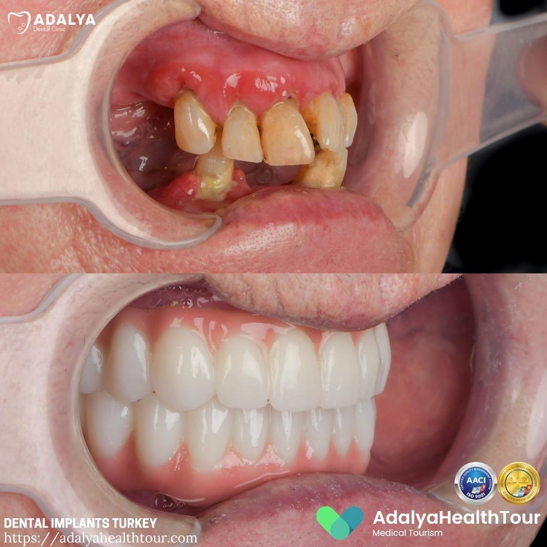 dental implants turkey before and after surgery