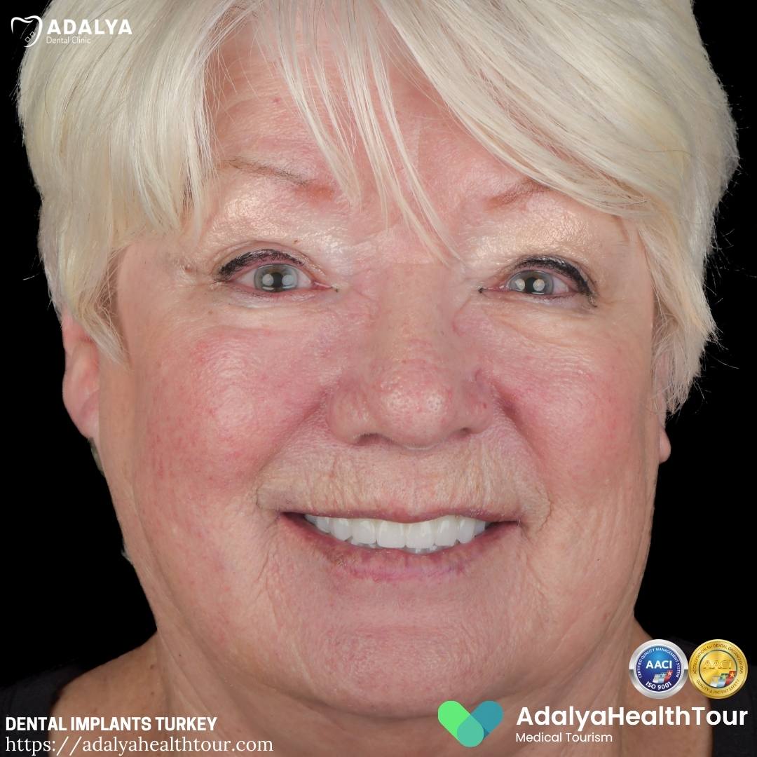 dental implants turkey before and after uk patient
