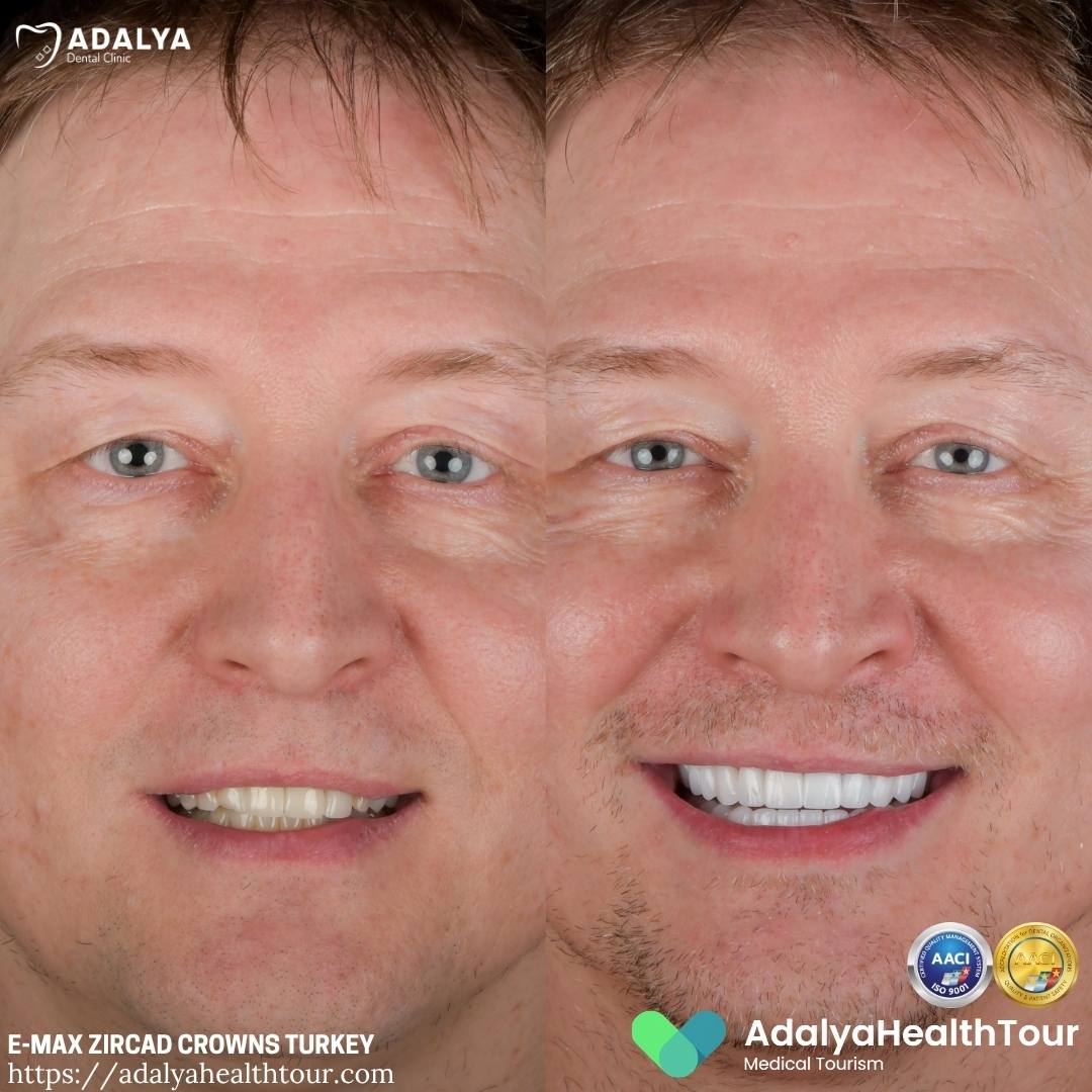 emax zircad crowns turkey before after norwegian patient