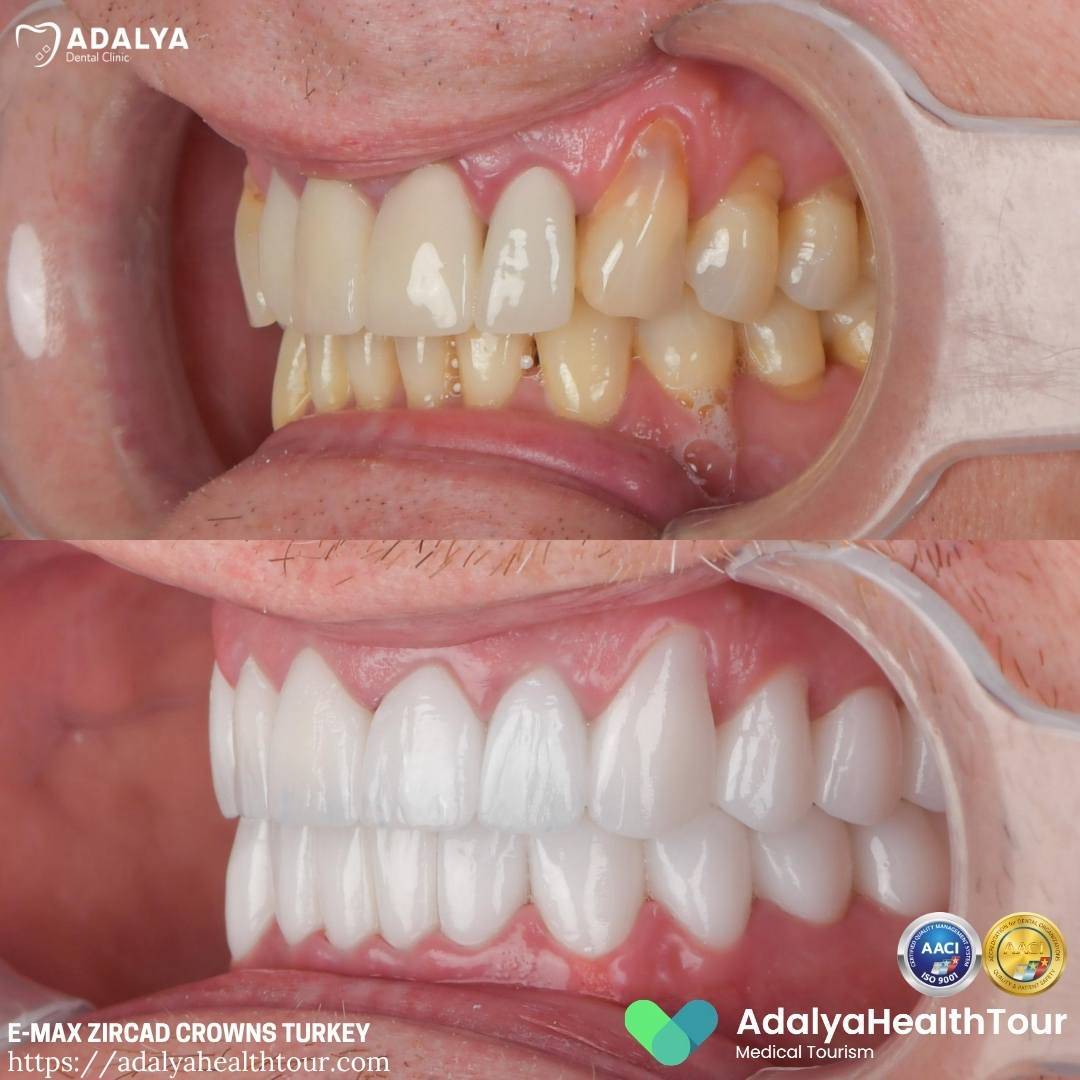 emax zircad crowns turkey before after