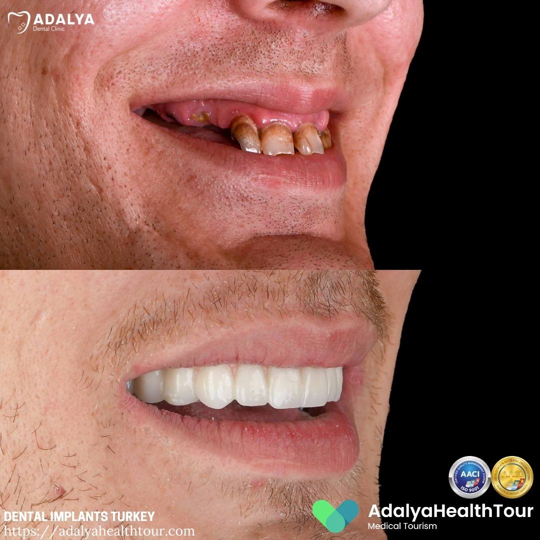 teeth implants turkey before after
