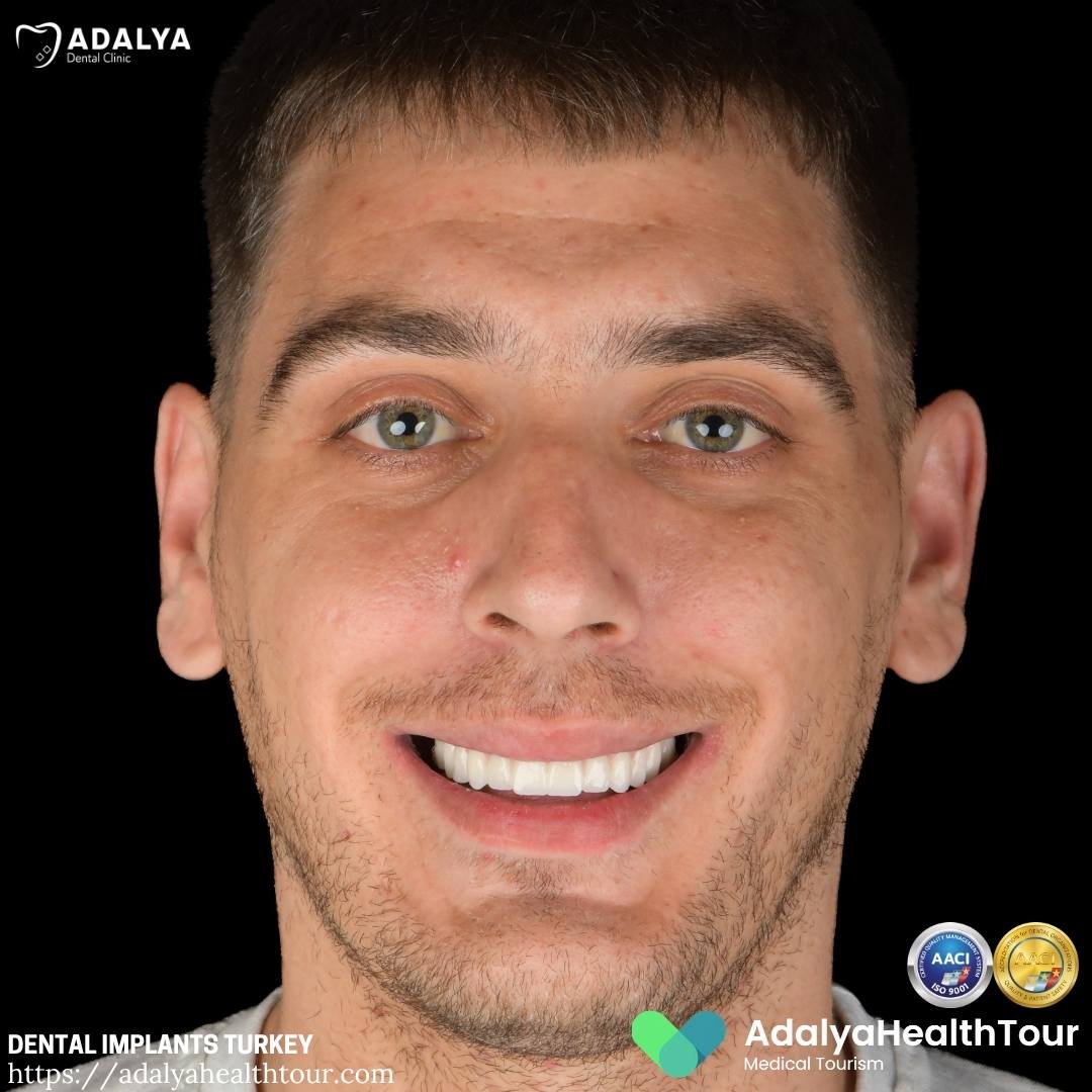 teeth implants turkey before and after latvian patient