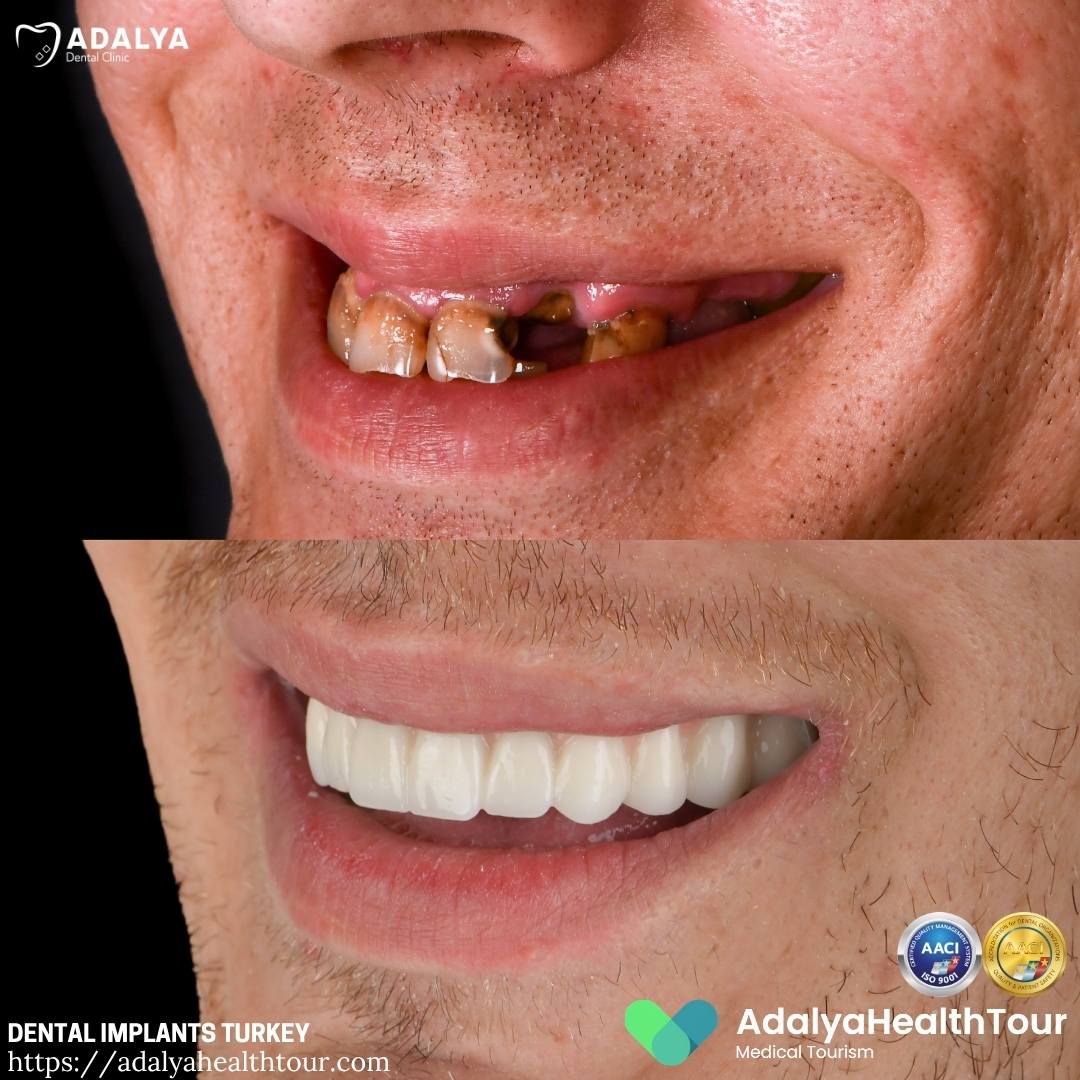 teeth implants turkey before and after surgery