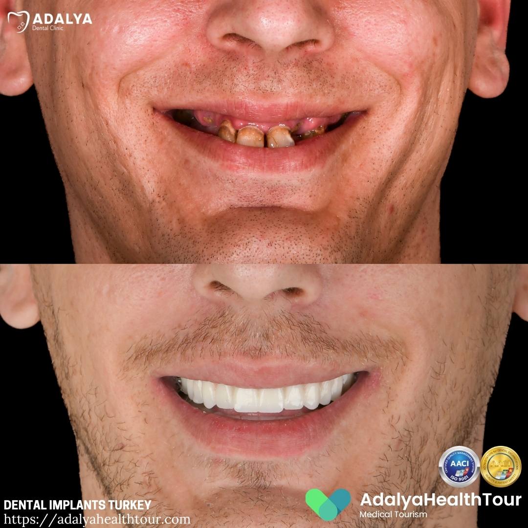teeth implants turkey before and after