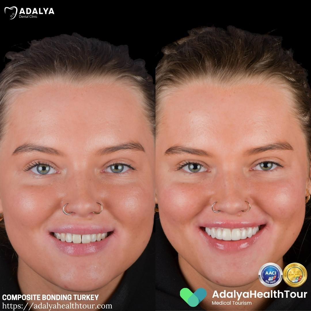 turkey composite bonding before after uk patient