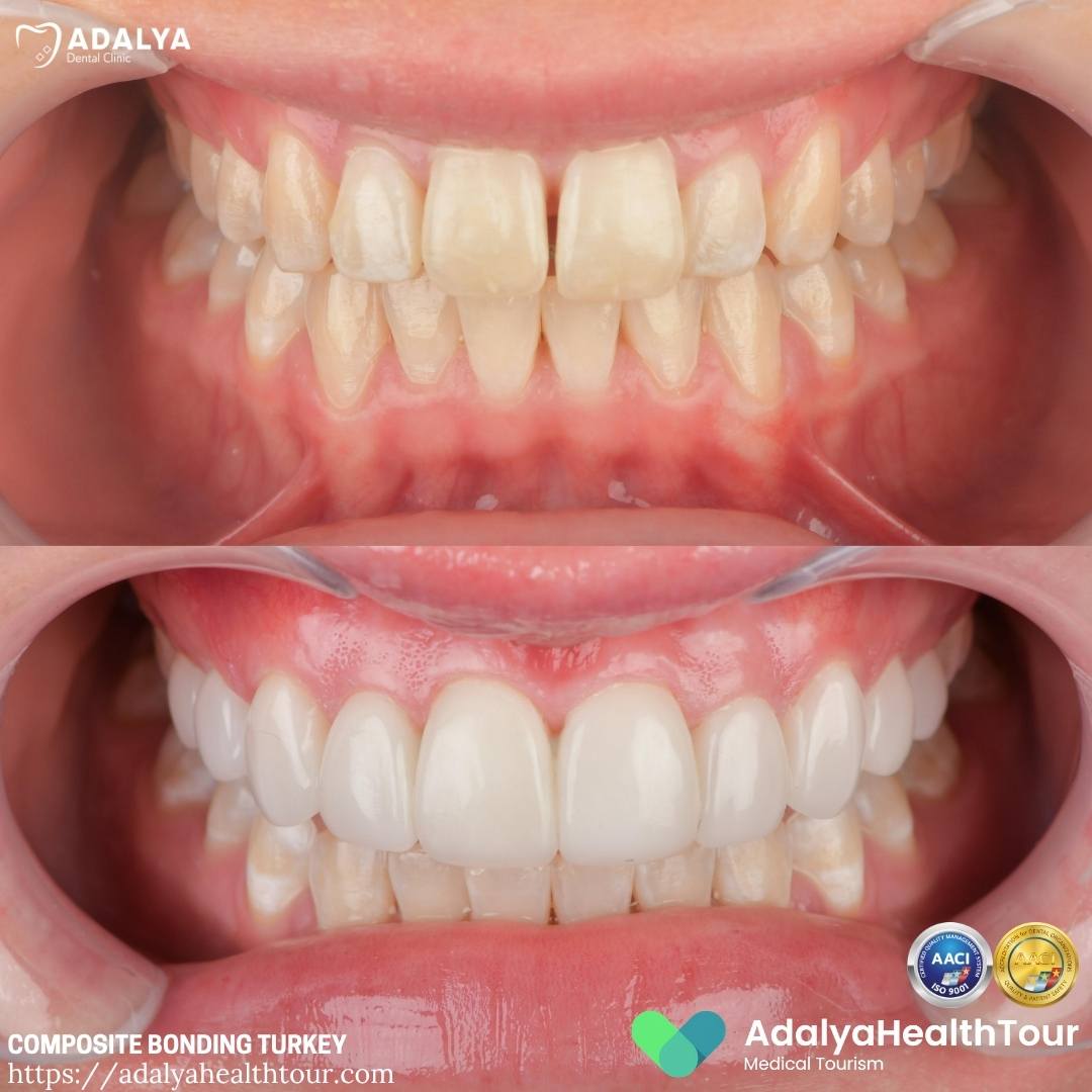 turkey composite bonding before after