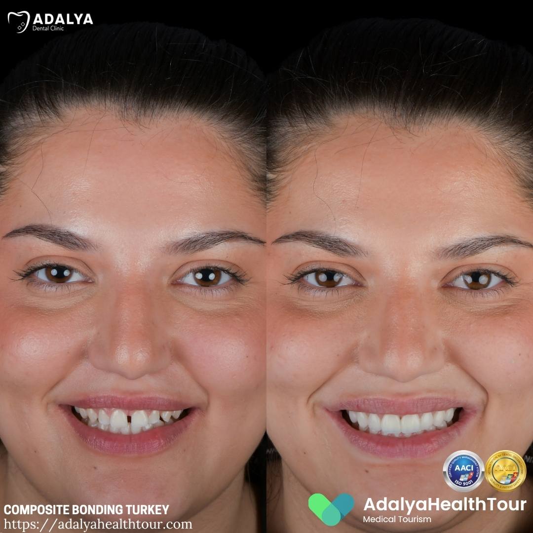 turkey dental bonding before after uk patient