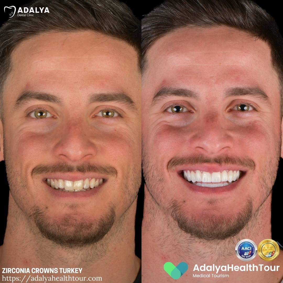 turkey dental crowns before after scottish patient