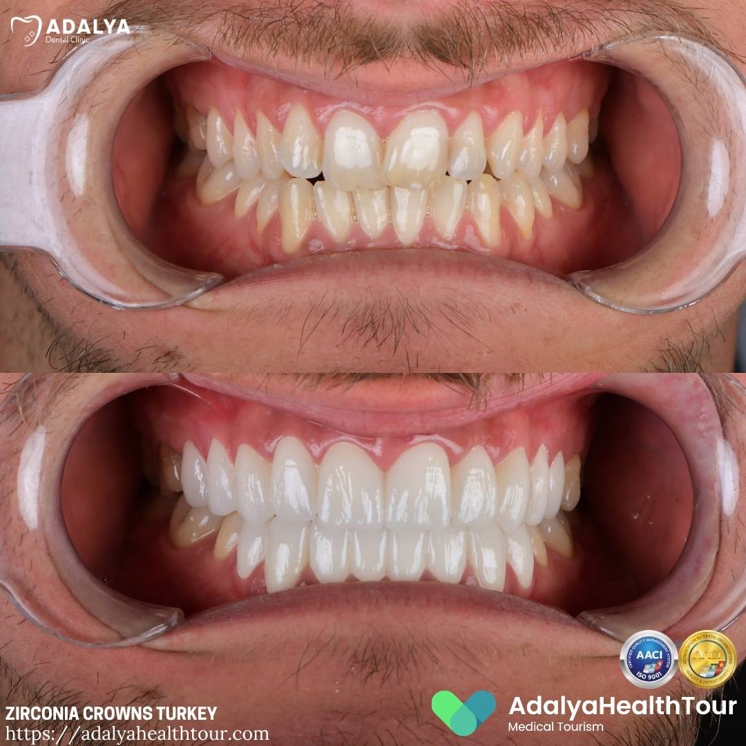 turkey dental crowns before after