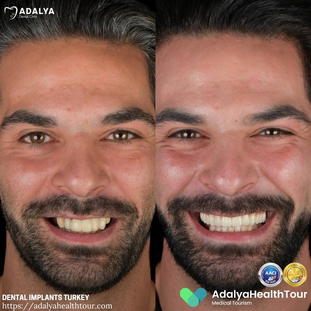 turkey dental implants before after dutch patient