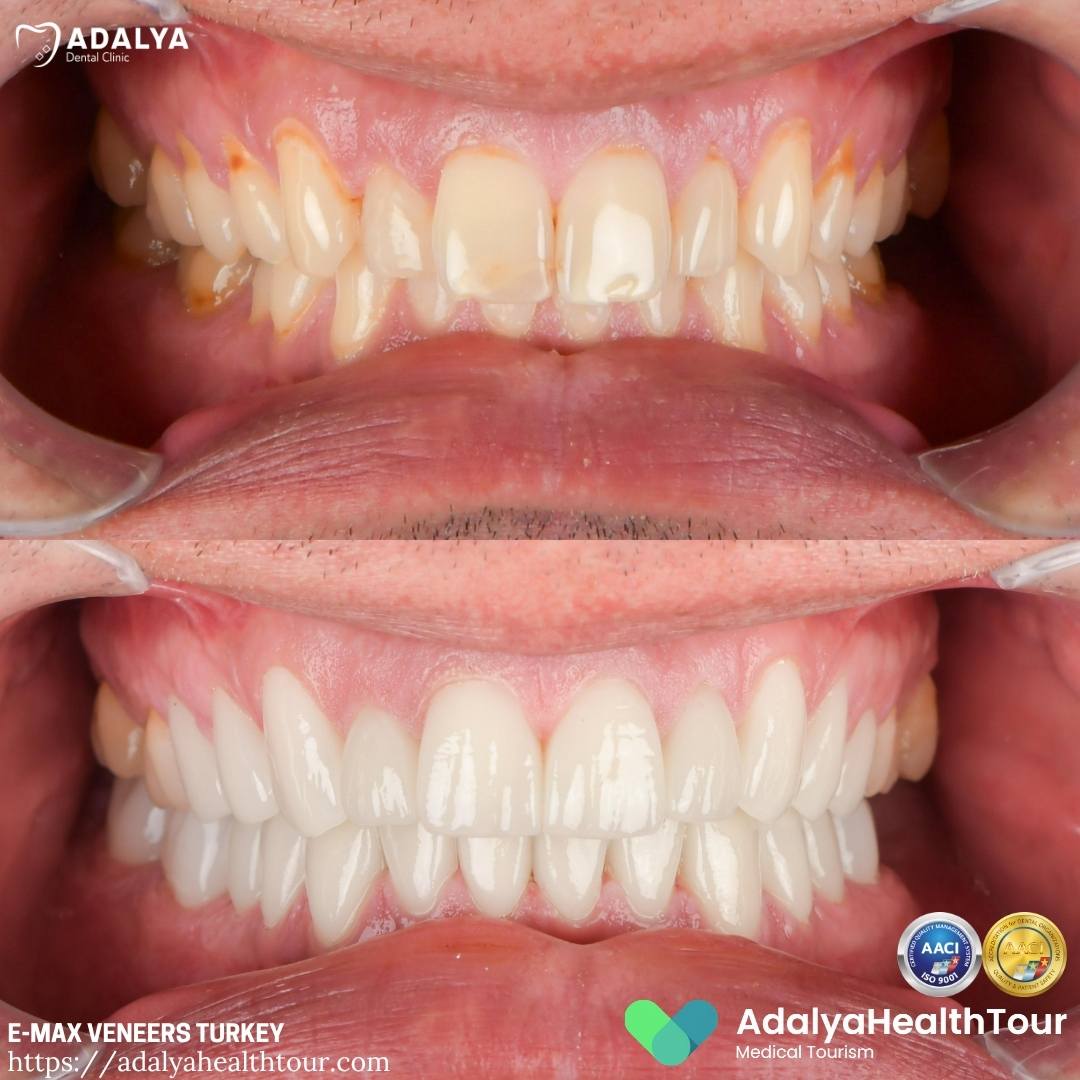 turkey dental veneers before after