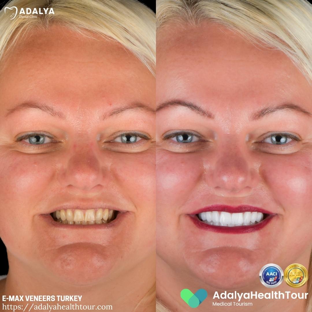 turkey emax crowns before after latvian patient