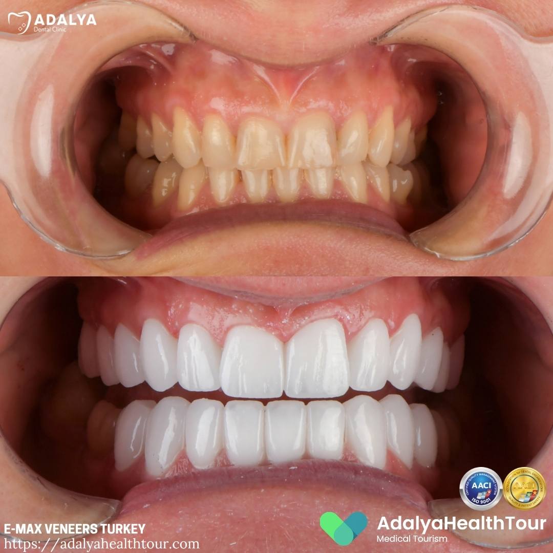 turkey emax crowns before and after