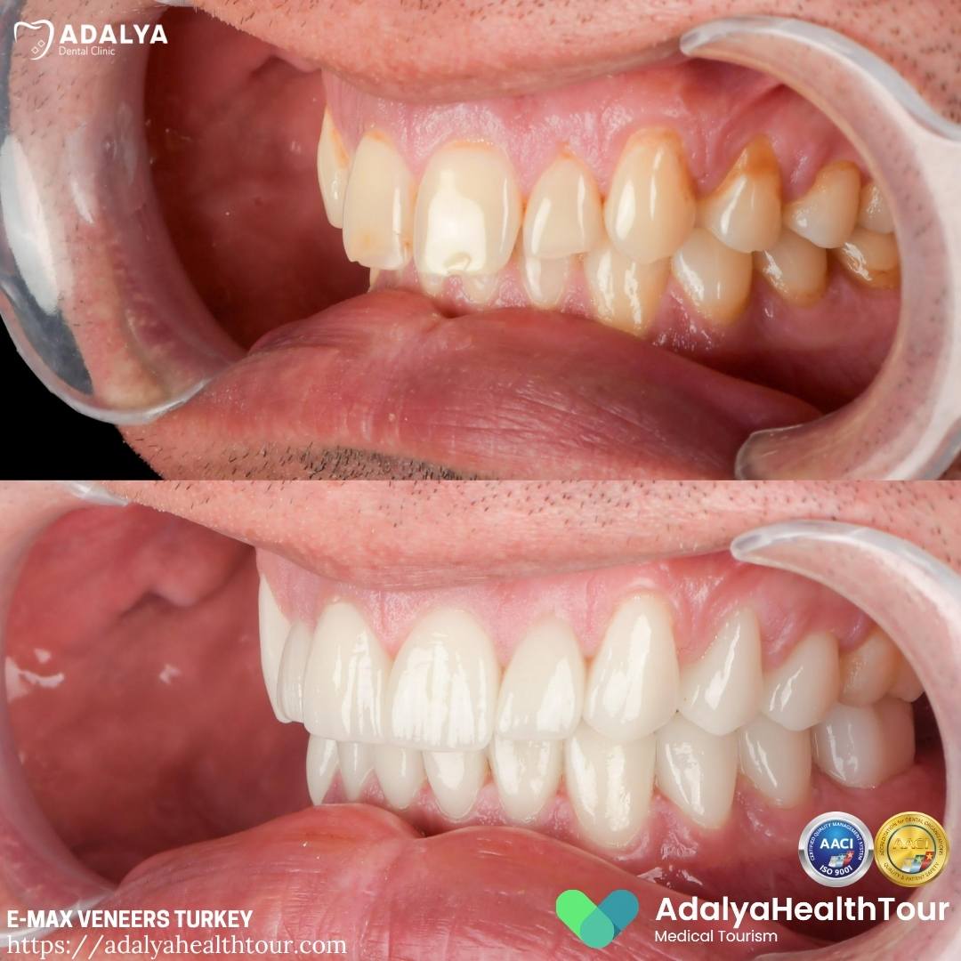 turkey emax dental veneers before and after