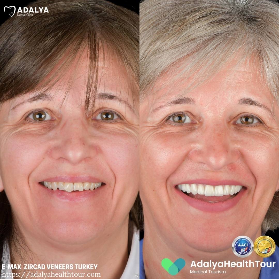 turkey teeth before after uk patient