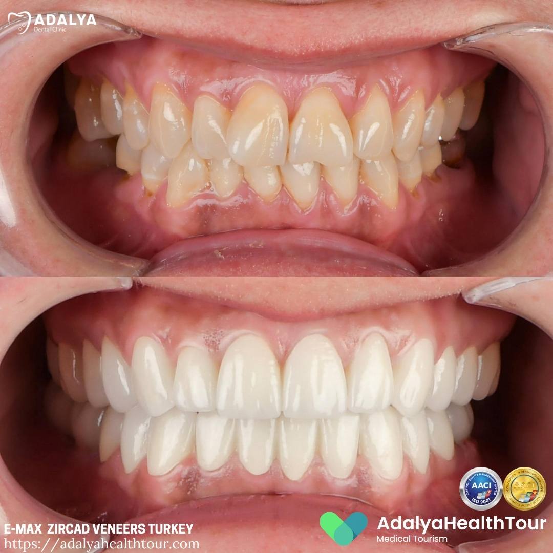 turkey teeth before and after