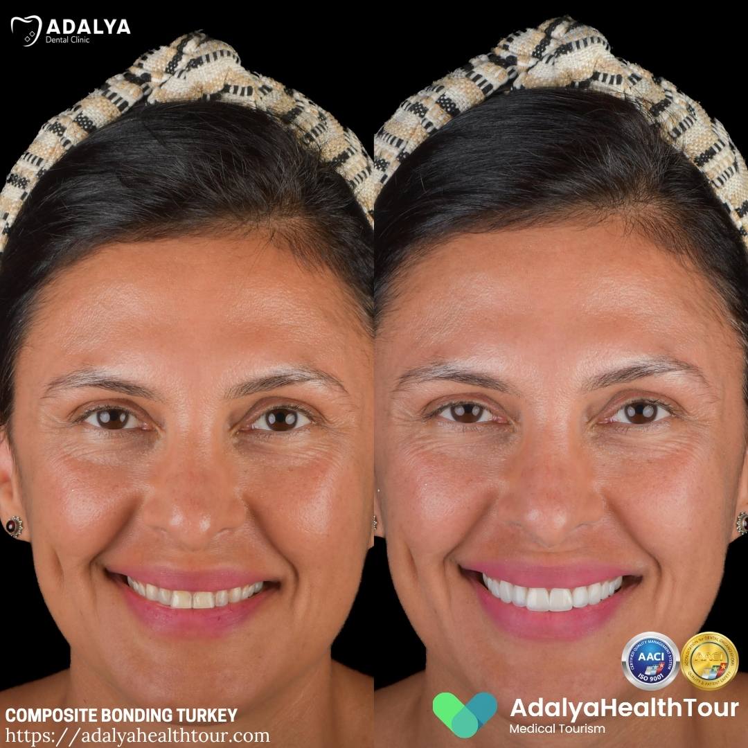 turkey teeth bonding before after german patient