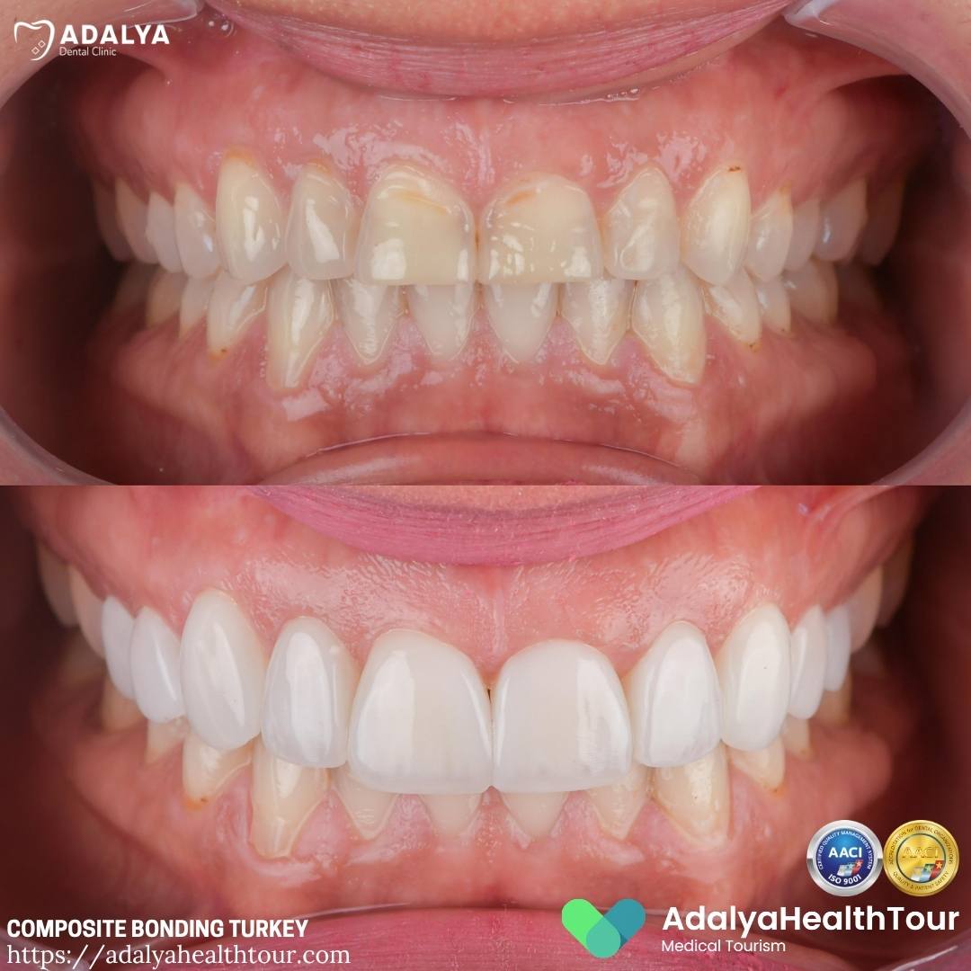 turkey teeth bonding before after
