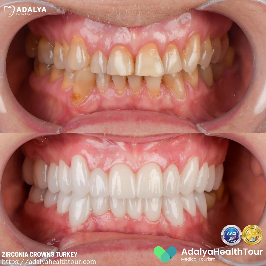 turkey teeth crowns before after