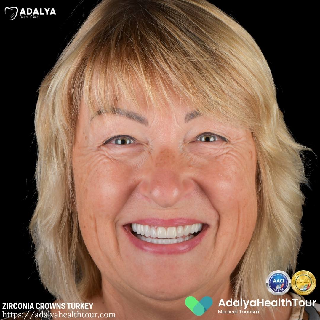 turkey teeth crowns before and after estonian patient