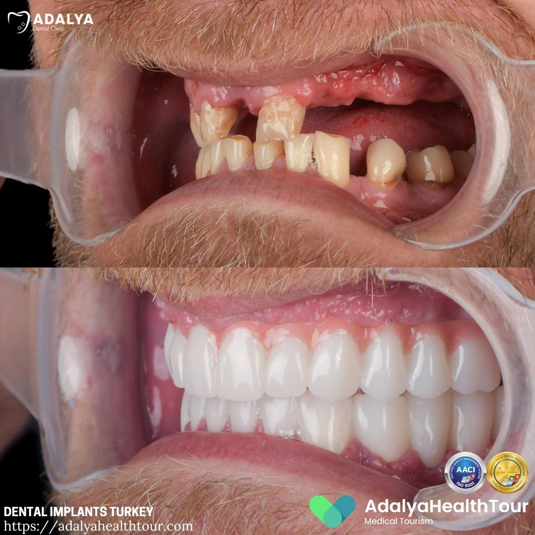 turkey teeth implant before and after surgery
