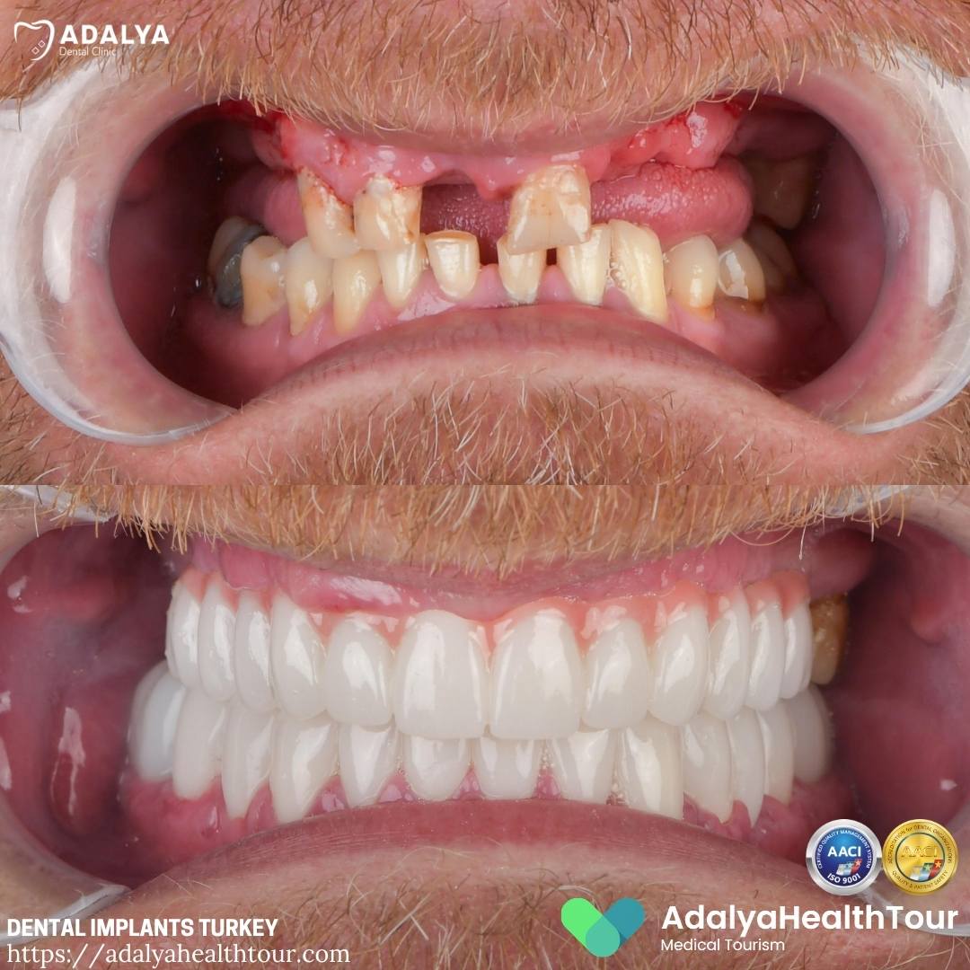 turkey teeth implant before and after