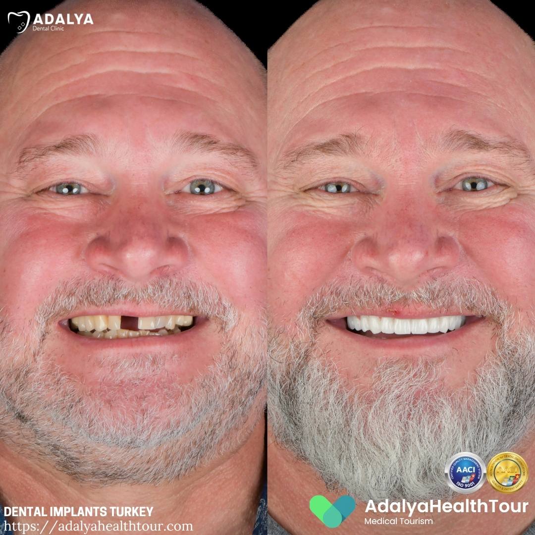 turkey teeth implants before after uk patient