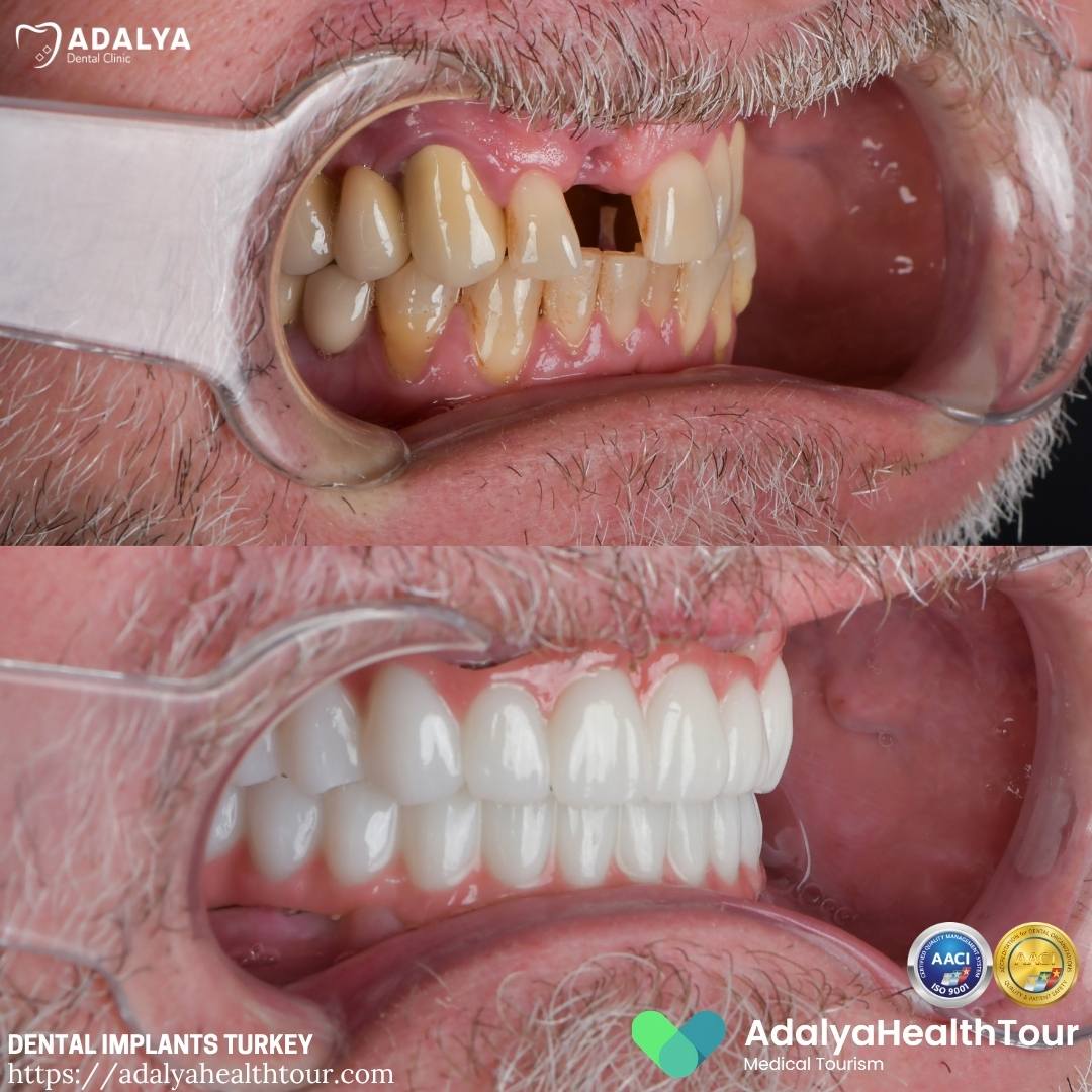 turkey teeth implants before after