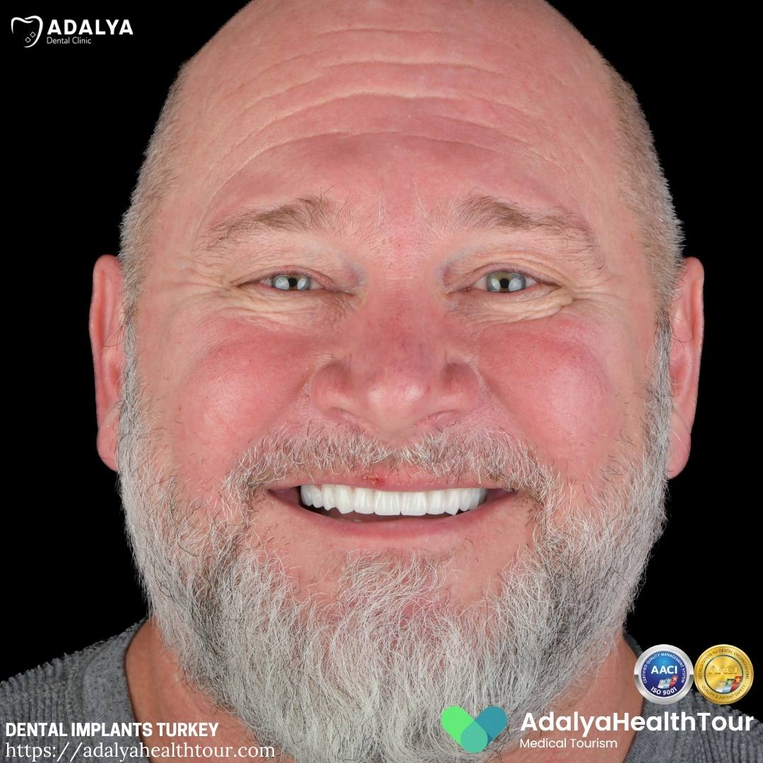 turkey teeth implants before after
