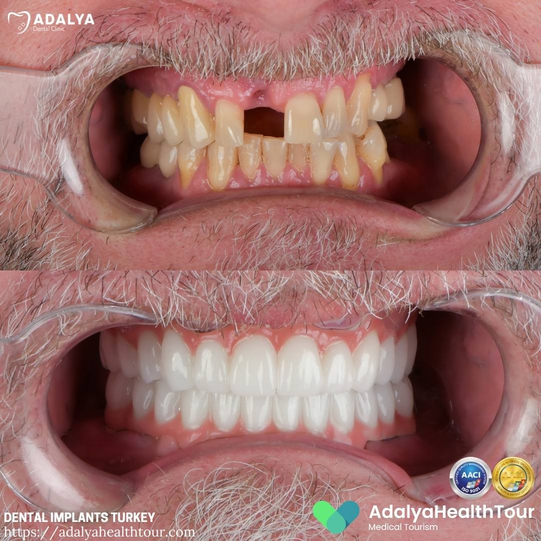 turkey teeth implants before and after