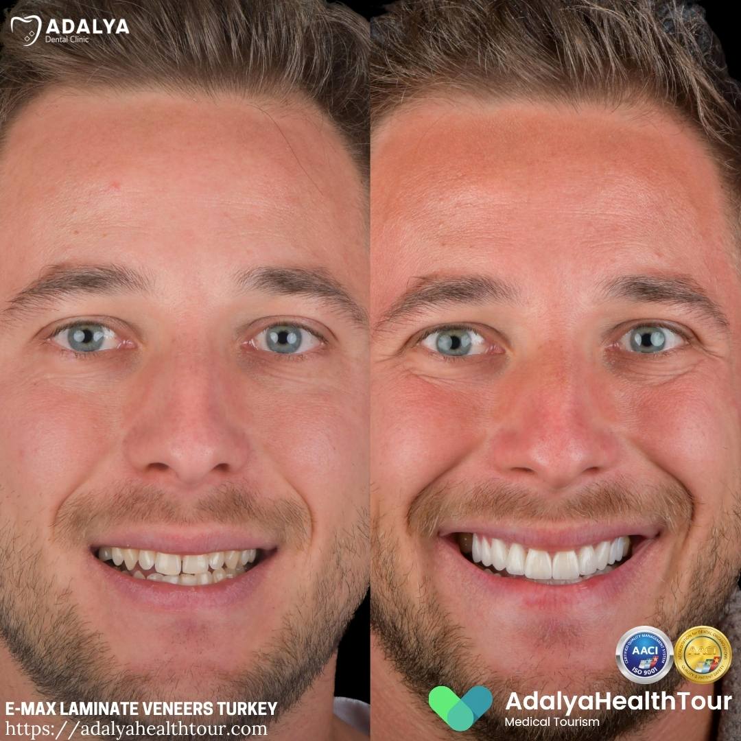 turkey teeth veneers before after german patient