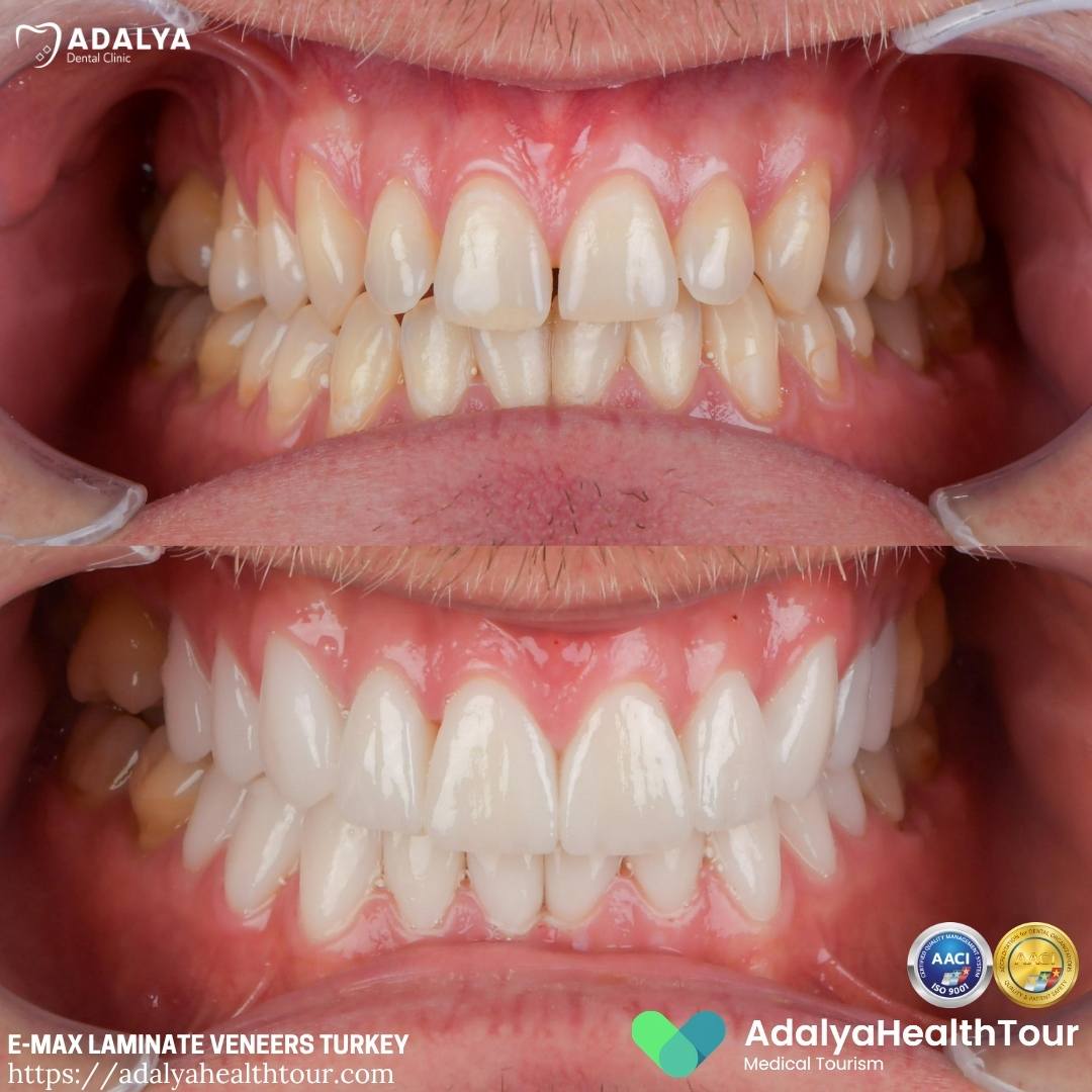 turkey teeth veneers before after
