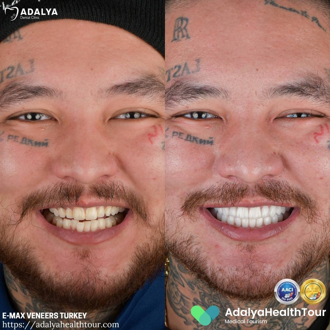turkey tooth before after german patient